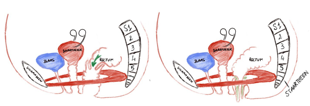 Interne prolaps (links) en externe prolaps (rechts)